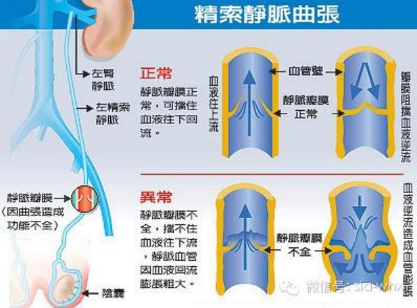關(guān)于2021年征兵精索靜脈曲張標(biāo)準(zhǔn)的探討，2021年征兵精索靜脈曲張標(biāo)準(zhǔn)深度解析