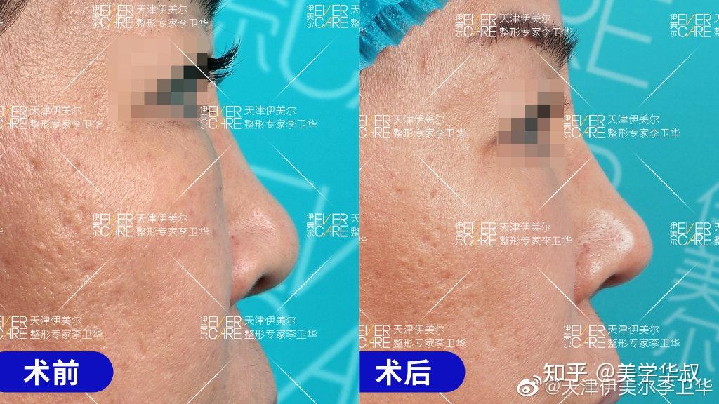 捏鼻三年，鼻頭變大——深度解析捏鼻子對鼻子的影響及應對之策，捏鼻三年的影響，鼻頭變大原因解析與應對之策