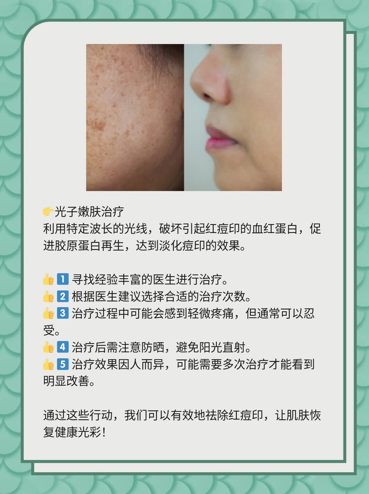 如何有效去除紅痘印，一站式解決方案，一站式解決紅痘印問題，有效去除方法大全