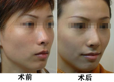 光子嫩膚做一次有效嗎？深入了解光子嫩膚的效果與過程，光子嫩膚效果與過程解析，做一次是否有效？