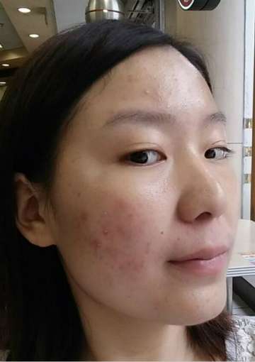 如何有效去除臉上痘痘——多種方法助您重拾肌膚光彩，多種方法助您有效去除臉部痘痘，重拾肌膚光彩