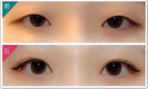埋線雙眼皮手術(shù)費(fèi)用詳解，價(jià)格因素與如何選擇合適的醫(yī)療機(jī)構(gòu)，埋線雙眼皮手術(shù)費(fèi)用解析，價(jià)格因素與醫(yī)療機(jī)構(gòu)選擇指南