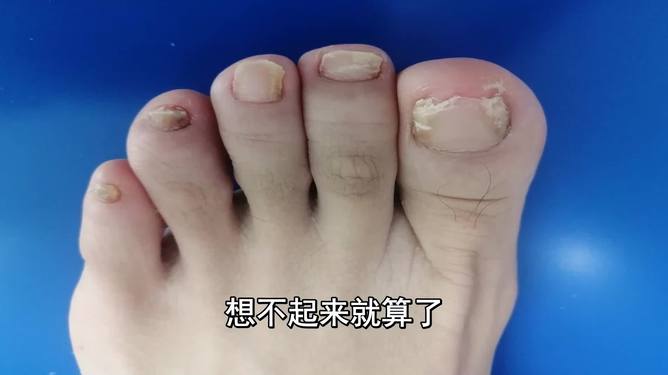 灰指甲由輕到重的圖片展示與解析，灰指甲病情進展圖片展示及解析