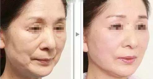 全面解析痤瘡皮膚，成因、治療與護(hù)理，全面解析痤瘡皮膚，成因、治療與護(hù)理指南