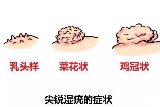 尖銳濕疣與艾滋病，并非必然的前兆關(guān)聯(lián)，尖銳濕疣與艾滋病，非必然前兆關(guān)聯(lián)探討