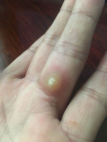 手上長(zhǎng)雞眼初期圖片，了解、預(yù)防與治療，手上長(zhǎng)雞眼，初期圖片、預(yù)防與治療方法全解析