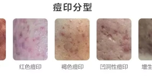 怎樣去痘印效果最好的方法，揭秘最佳去痘印方法，告別臉部瑕疵！