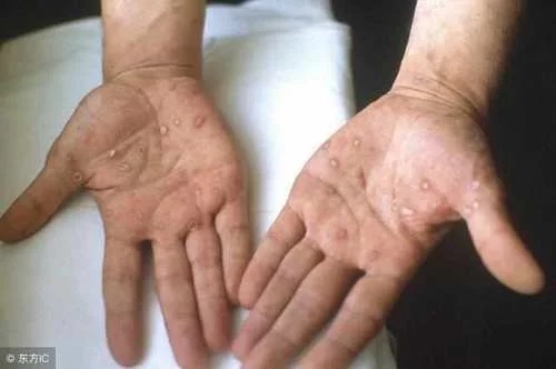 男人得梅毒的六個(gè)前兆，了解并預(yù)防梅毒癥狀，男人得梅毒的六個(gè)前兆，如何預(yù)防梅毒癥狀的出現(xiàn)