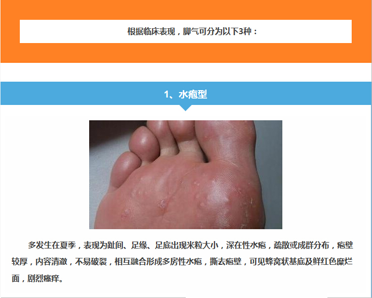 水泡型腳氣怎么治能除根——全面解析最佳治療方案，水泡型腳氣根治攻略，全面解析最佳治療方案
