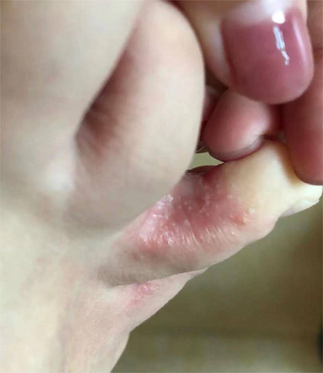 腳氣爛腳趾縫癢潰爛的治療方法，全面解析與有效策略，腳氣爛腳趾縫癢潰爛全面解析與治療方法探討