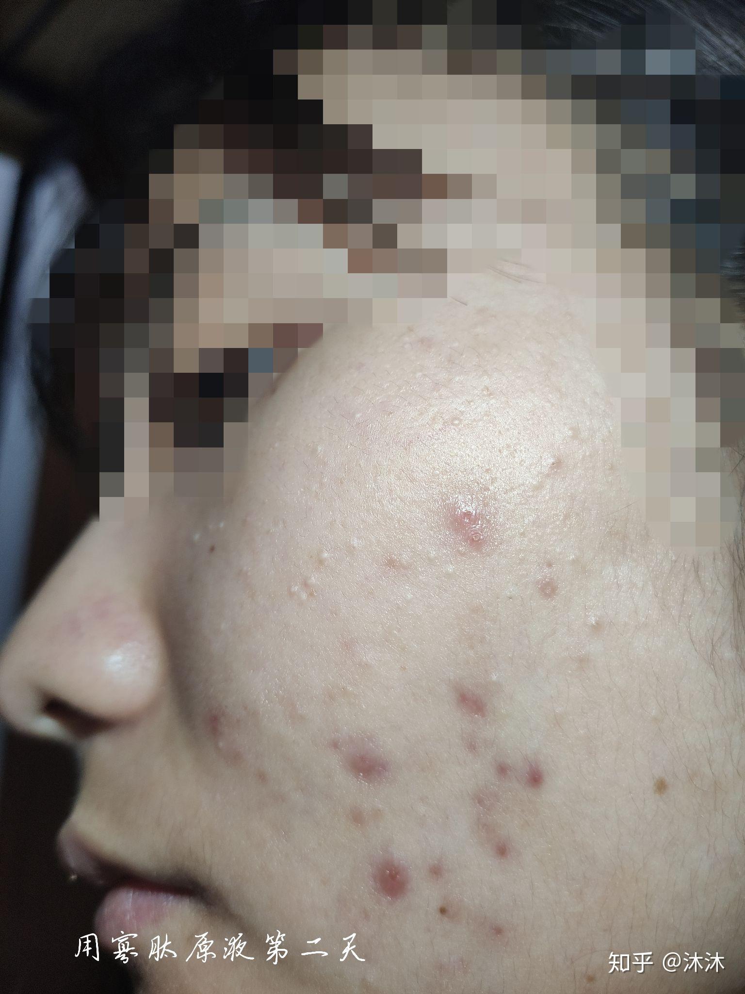 臉上起痤瘡怎么根除，全面解析與有效方法，全面解析，根除痤瘡的有效方法與日常護(hù)理建議