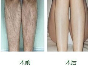 激光脫毛，價(jià)格因素詳解，激光脫毛詳解，價(jià)格因素剖析