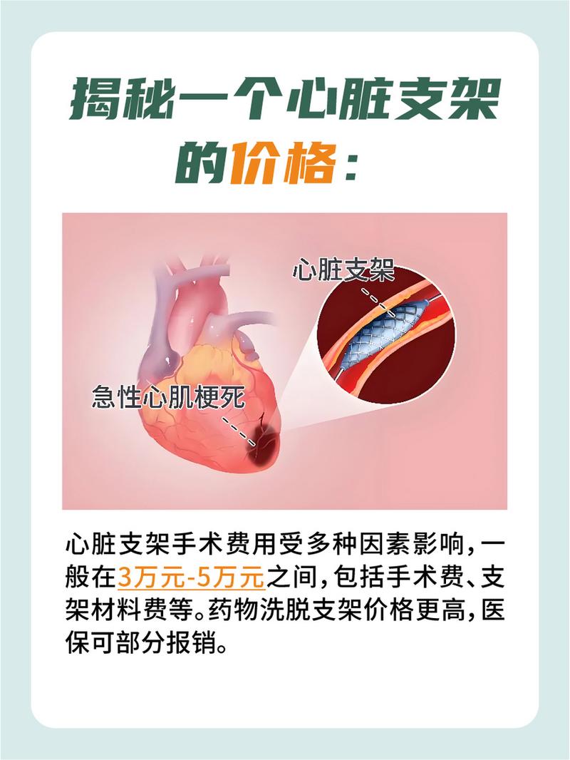 關(guān)于血管支架的價(jià)格，你需要知道的一切，血管支架價(jià)格全解析，你需要了解的一切