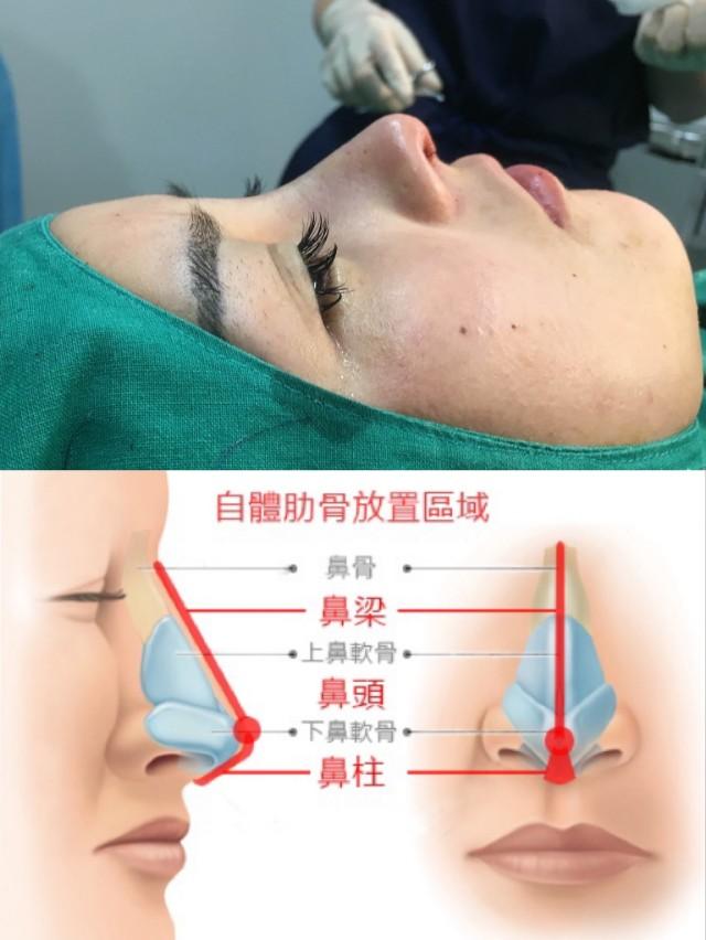 鼻綜合整形項(xiàng)目詳解，包括哪些項(xiàng)目？，鼻綜合整形項(xiàng)目詳解，涵蓋內(nèi)容與整形項(xiàng)目概覽
