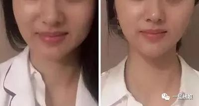 瘦臉針打三次就可以永久定型了嗎？深度解析瘦臉針效果與注意事項，深度解析，瘦臉針效果及注意事項——打三次能否永久定型？