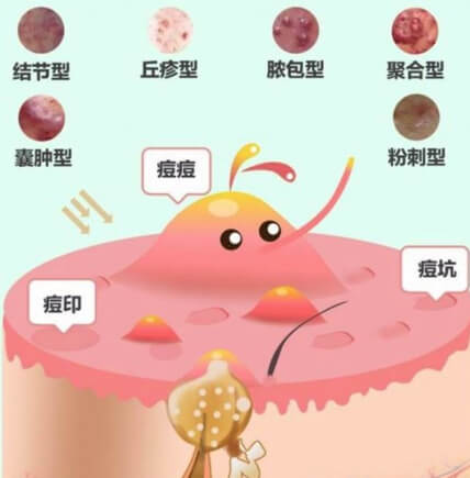 痤瘡忌口食物清單，戰(zhàn)勝痘痘，從飲食開始，戰(zhàn)勝痘痘，痤瘡忌口食物清單助你調(diào)整飲食，遠(yuǎn)離皮膚困擾