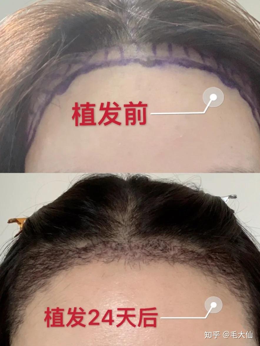 關(guān)于發(fā)際線植發(fā)的費(fèi)用，你需要知道的一切，發(fā)際線植發(fā)費(fèi)用全解析