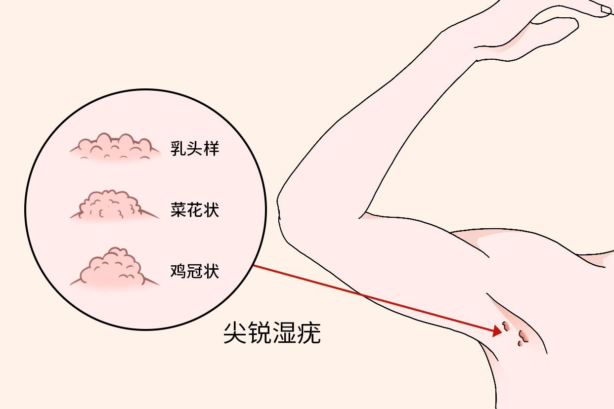 尖銳濕疣圖片，了解、識別與防治，尖銳濕疣圖片詳解，識別、防治全攻略