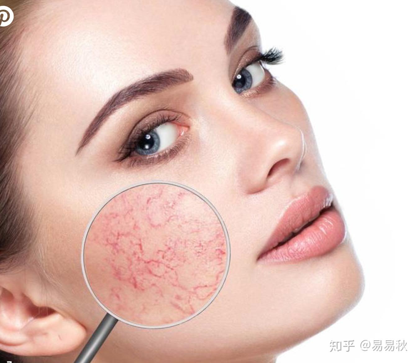 改善面部紅血絲的方法，改善面部紅血絲的有效方法