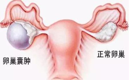 卵巢囊腫的十個(gè)征兆，卵巢囊腫的十個(gè)征兆解析