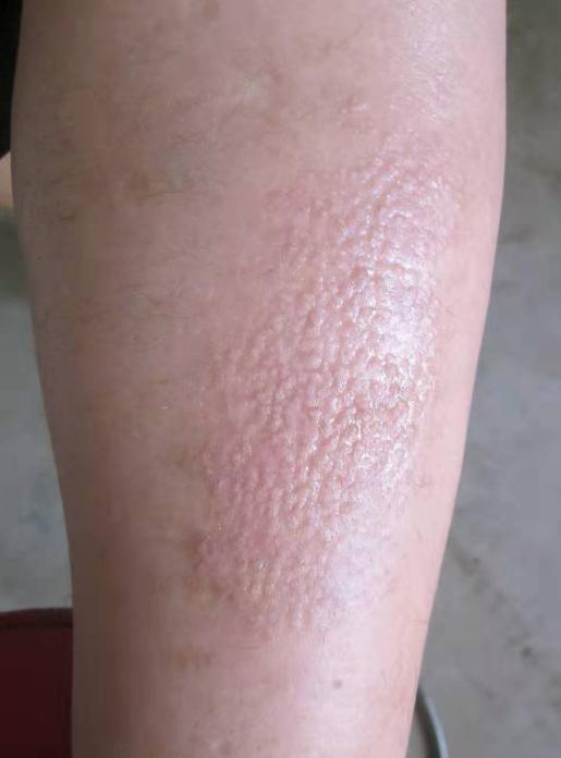 無緣無故長疙瘩又紅又癢，原因解析與應(yīng)對(duì)策略，無緣無故長紅癢疙瘩，原因解析及應(yīng)對(duì)方法