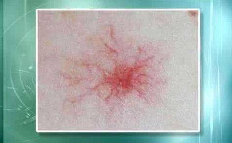 肝癌身上出現(xiàn)紅點圖片，癥狀解析與關(guān)注，肝癌身上紅點解析，癥狀、圖片及關(guān)注重點