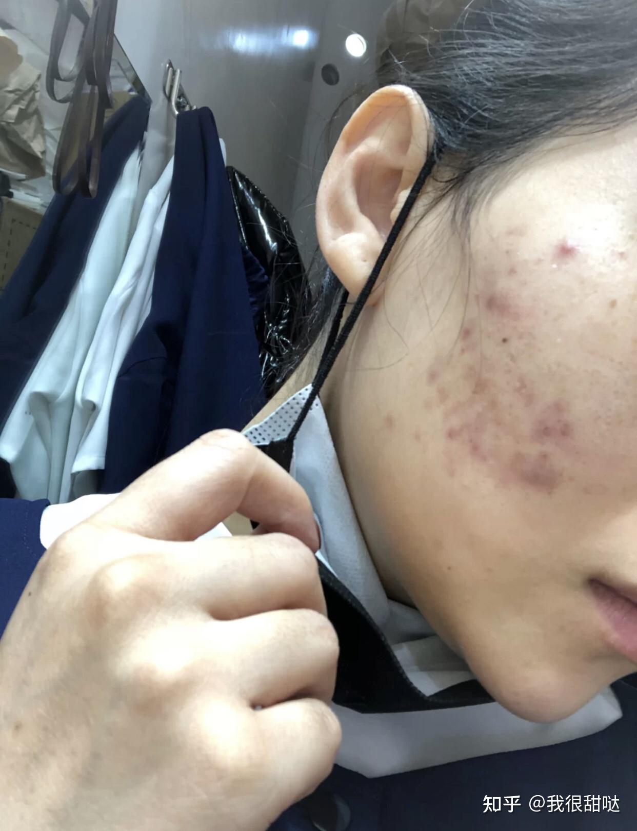 怎樣去除青春痘及痘印，全面解析有效方法，全面解析，青春痘與痘印的去除有效方法