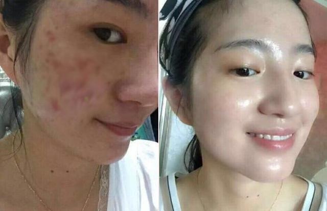 痘印多久會自己消失？全面解析痘印消失時(shí)間與影響因素，痘印消失時(shí)間全面解析，影響因素與消失時(shí)長探討