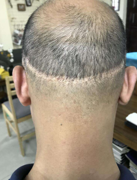 植發(fā)效果的持久性，能否長期維持與多種因素相關，植發(fā)效果的持久性與多種因素關聯，長期維持探討