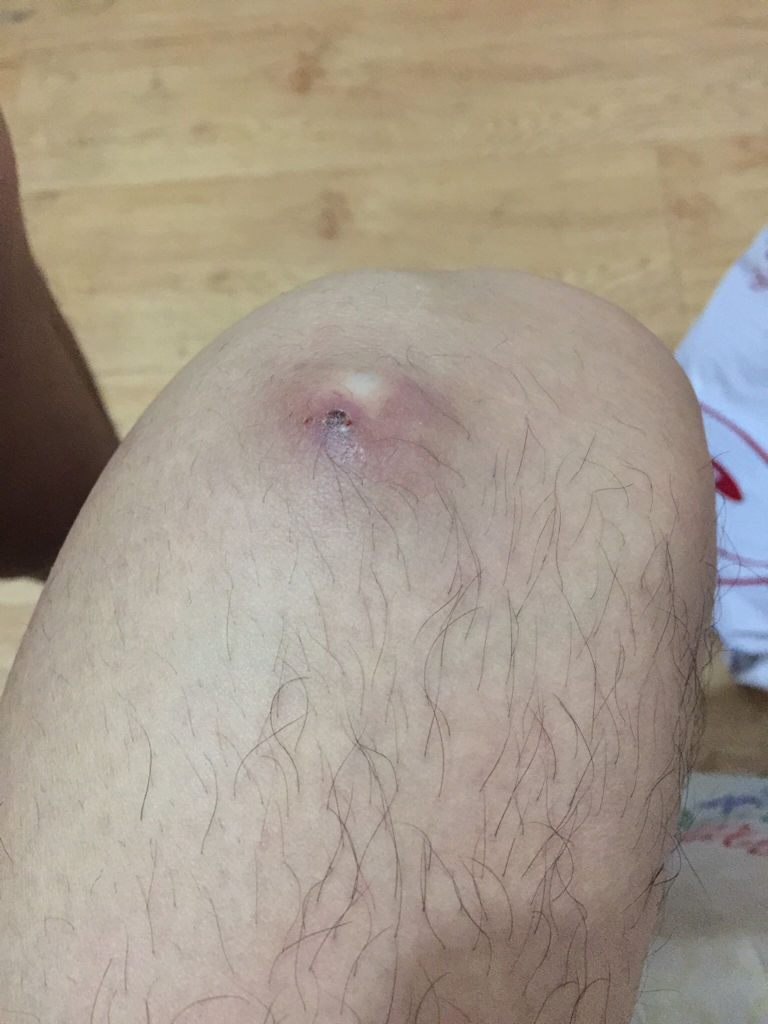 痘痘長(zhǎng)不出來(lái)，肉里硬硬的，原因解析與應(yīng)對(duì)建議，痘痘無(wú)法冒出表面，內(nèi)部硬結(jié)成因解析及應(yīng)對(duì)之策