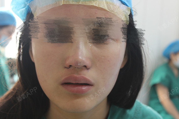 不動手術(shù)縮小鼻頭，自然方法與實(shí)用技巧，自然縮小鼻頭的方法與實(shí)用技巧分享